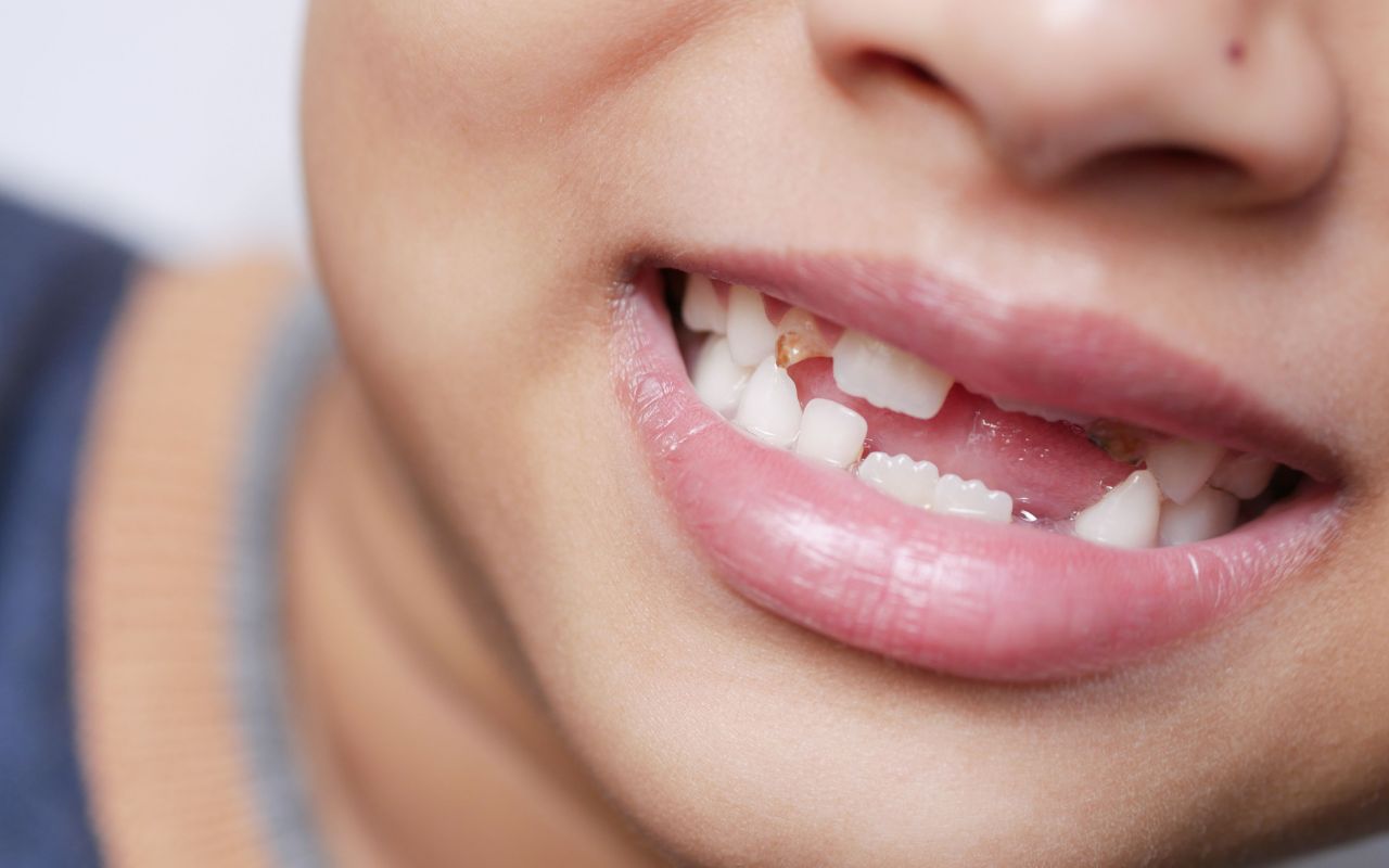 Denti storti e sorriso irregolare: le soluzioni più efficaci Denti storti e sorriso irregolare: le soluzioni più efficaci