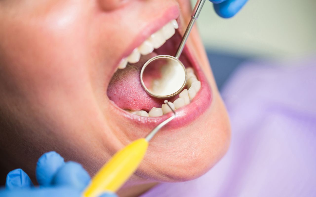 Pulpite dentale Pulpite dentale