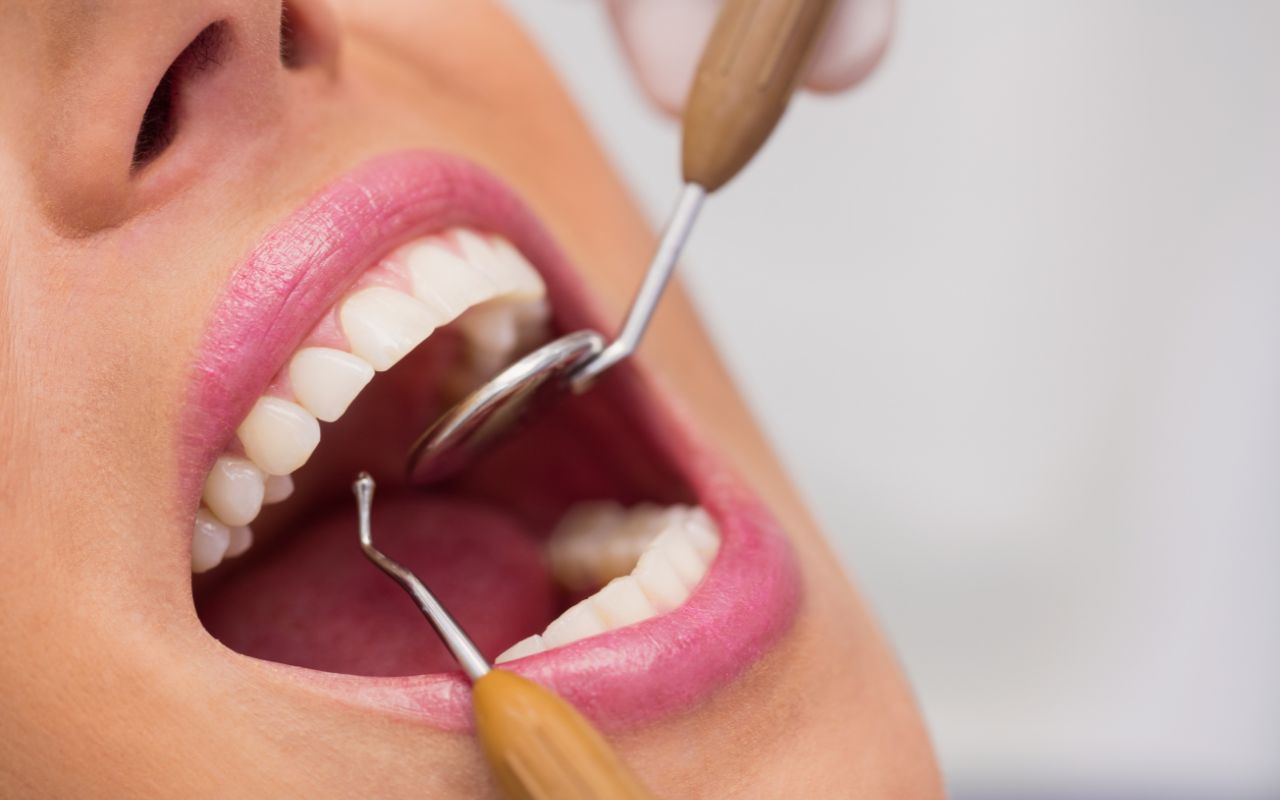 Corona dentale a Milano: La soluzione per denti danneggiati